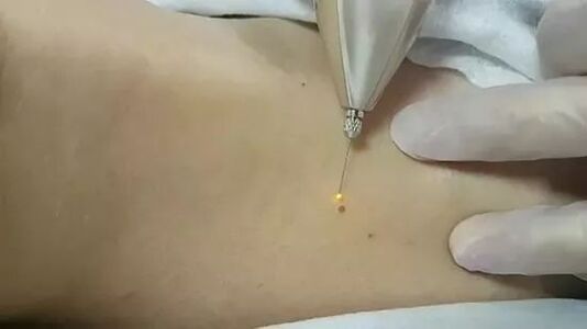 Papillome Elimination
