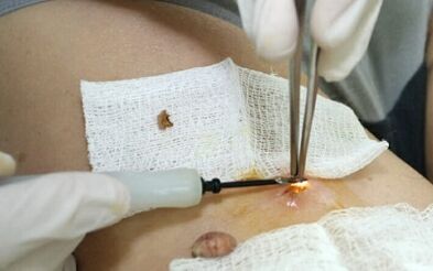 Chirurgische Behandlung des menschlichen Papillomavirus