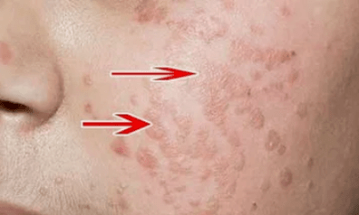 Wie man menschliches Papillomavirus erkennt