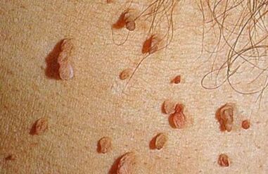 Wie sich der menschliche Papillomavirus manifestiert