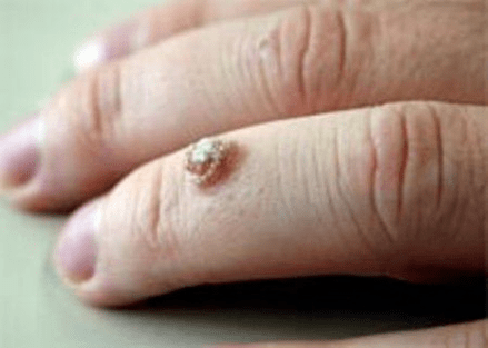 Verruga am Finger