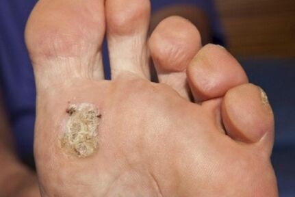 Die Gründe für das Aussehen einer Plantarfarm