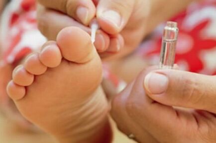 Methoden zur Behandlung von Plantarwarzen