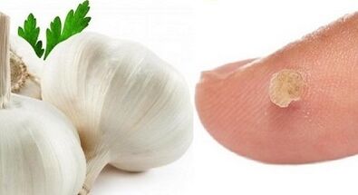 Warzenbehandlung mit Hausmitteln