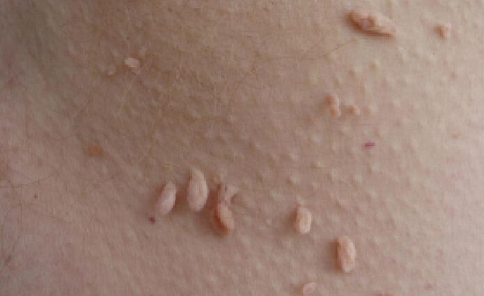 Gründe für das Auftreten von Papillomen am menschlichen Körper.