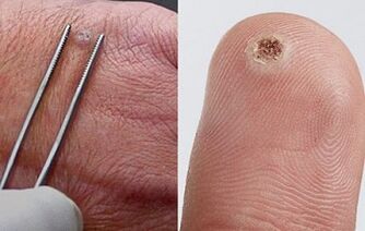 Symptome von Papillomen am menschlichen Körper