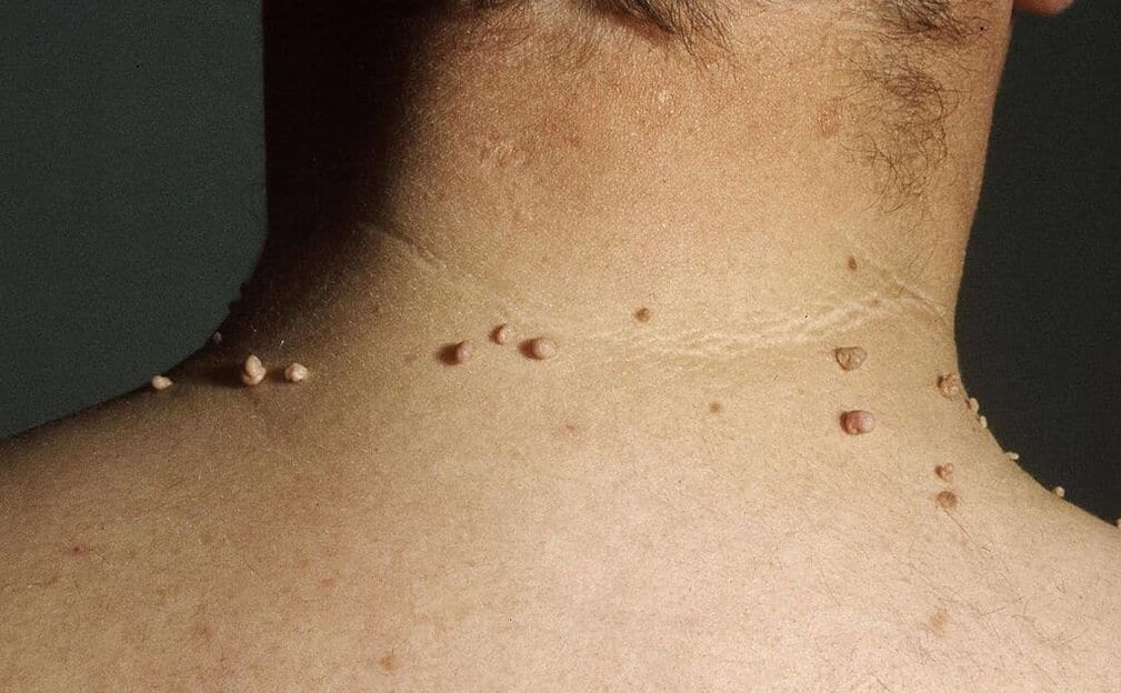 Ursachen für Papillome am Hals